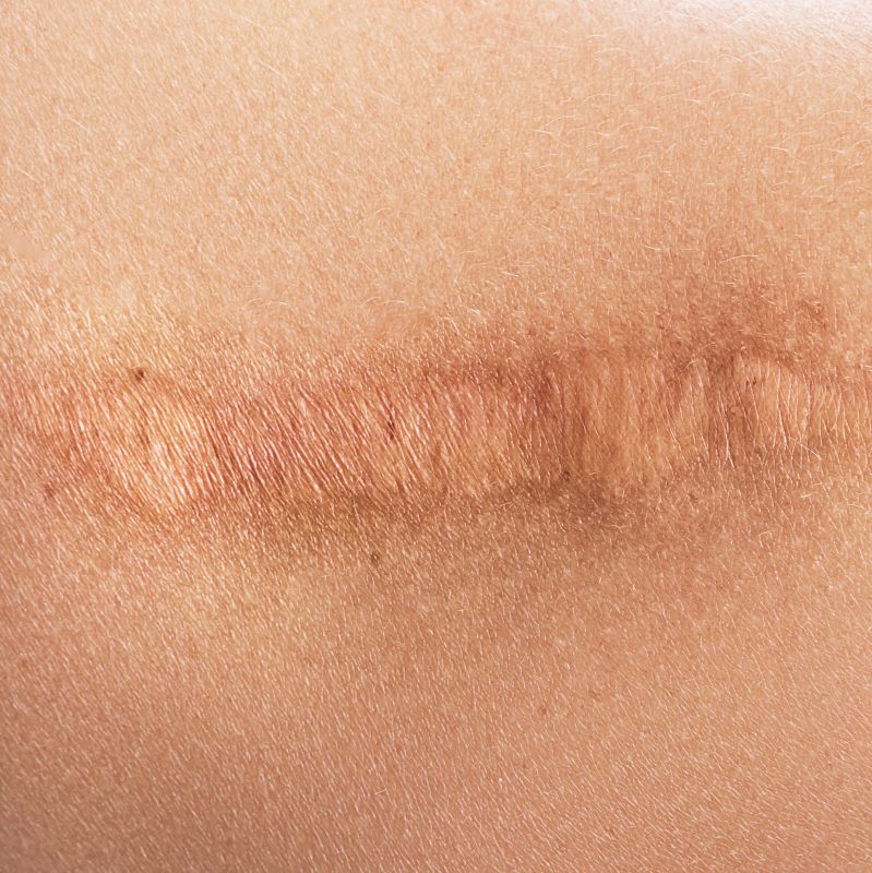 Hegkezelés - Renáta Gyógytorna