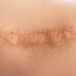 Hegkezelés- Renáta Gyógytorna